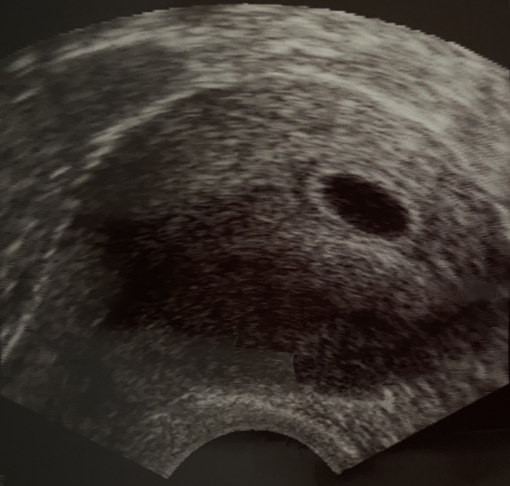 6 ssw nichts zu sehen? — BabyForum.at