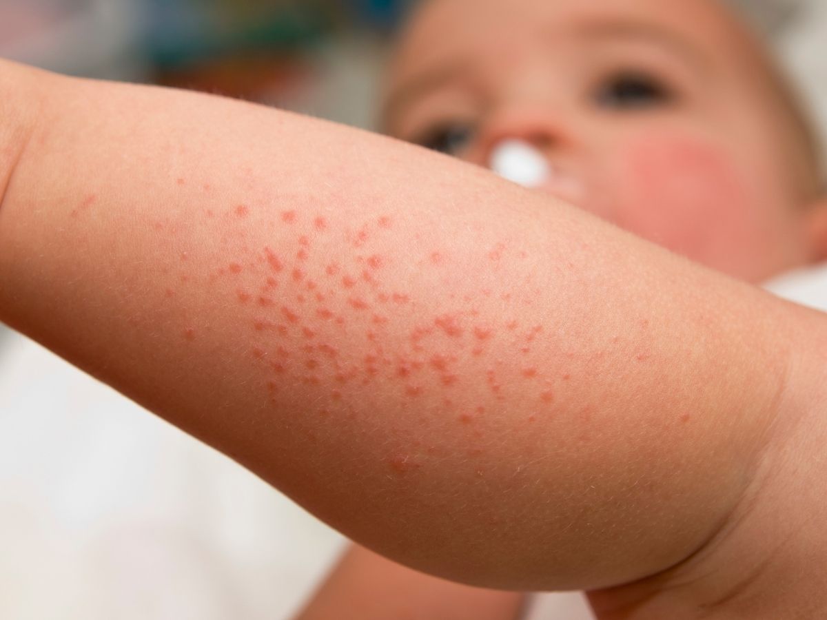 How to Effectively Treat an Infant’s Heat Rashes? BabyStuffLab