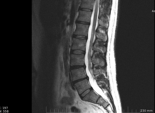Your MRI may be the wrong medicine to determine treatment for sciatic pain.
