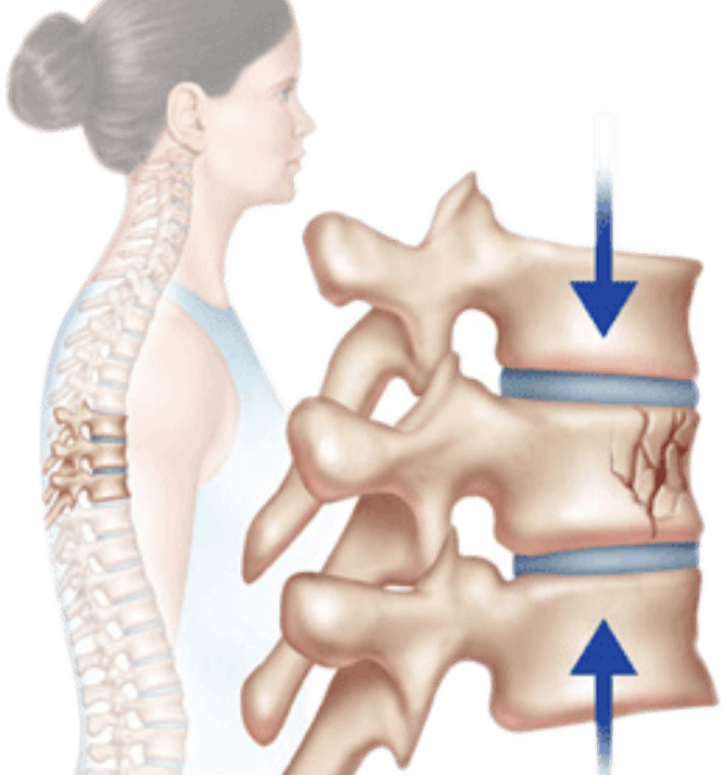 Compression Fractures Treatment Back Pain Treatment