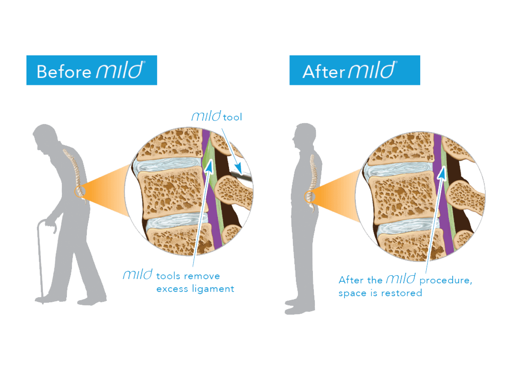 MILD Procedure for Spinal Stenosis- Back Pain Treatment
