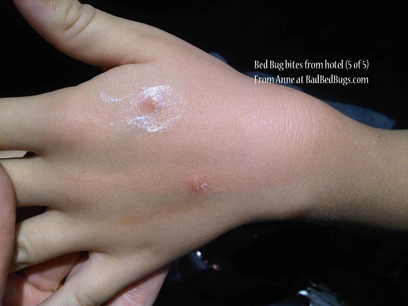 Hotel Bedbugs Check Registry of Hotels for Bed Bugs