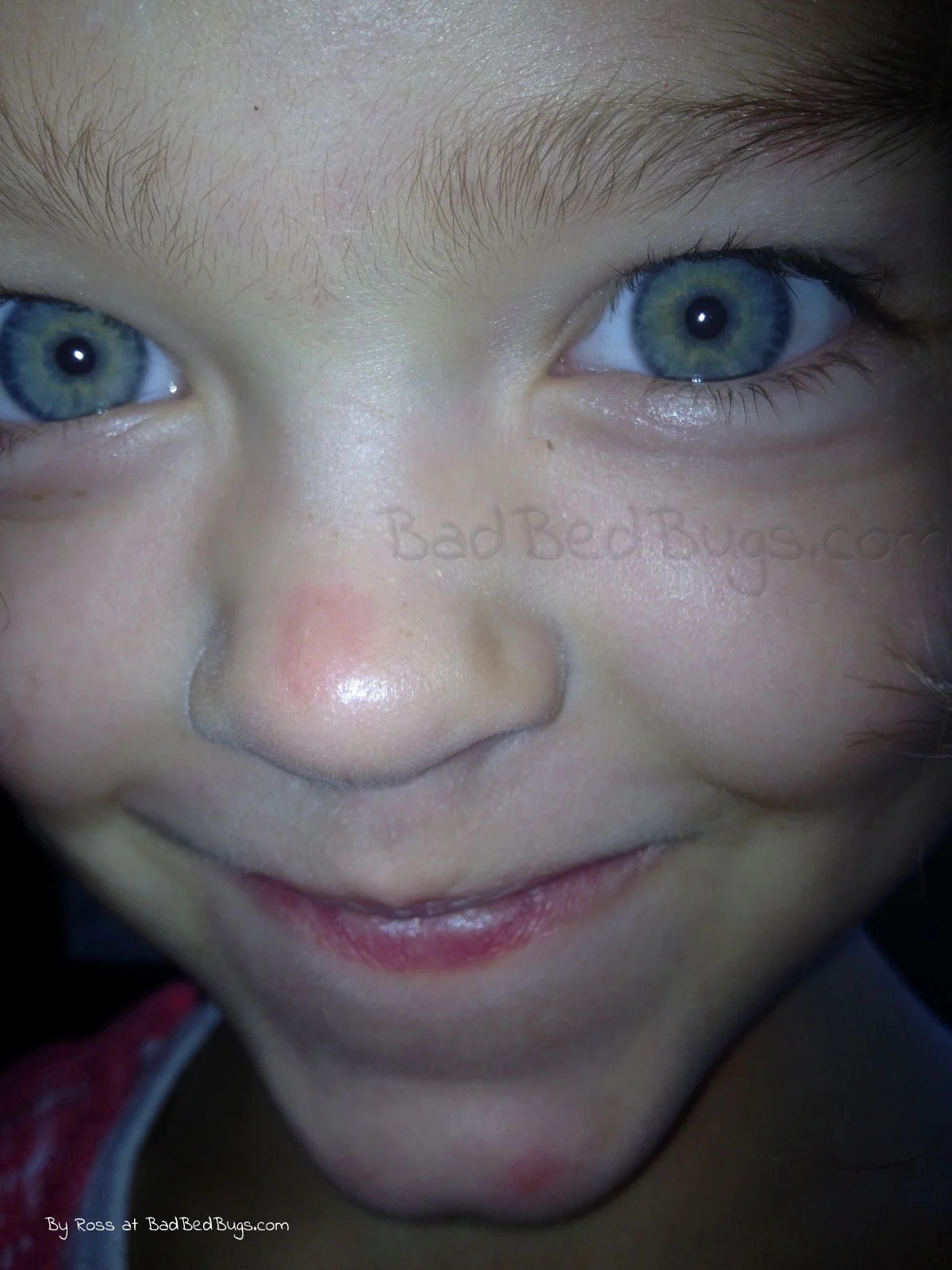 Bed Bug Bites Pictures and Photo of Bedbug Attacks