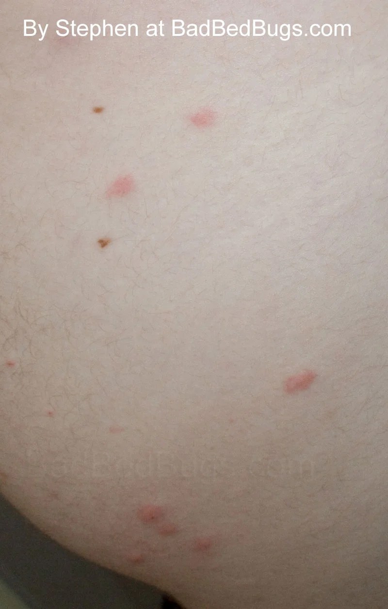 Bed bug legs Discussion 3
