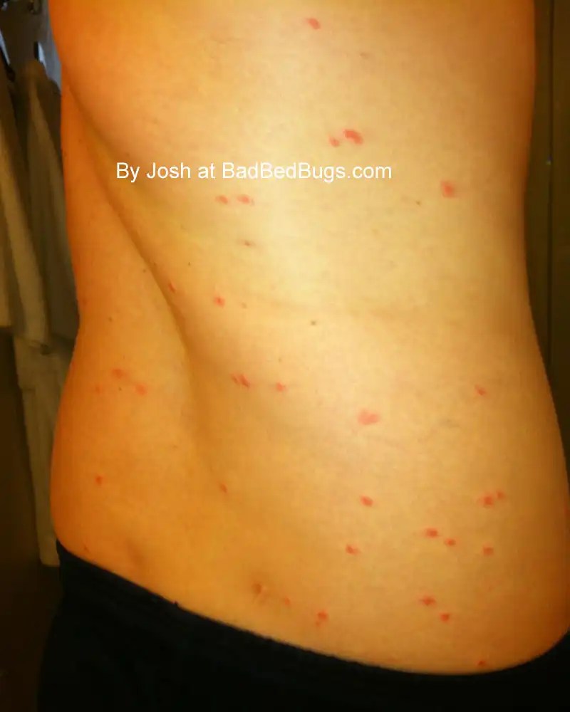 Pictures of Bed Bug Bites Photos of People Bitten by Bed Bugs