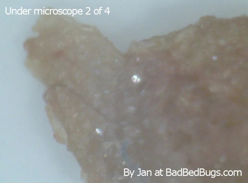 Mite Bites On Human Skin