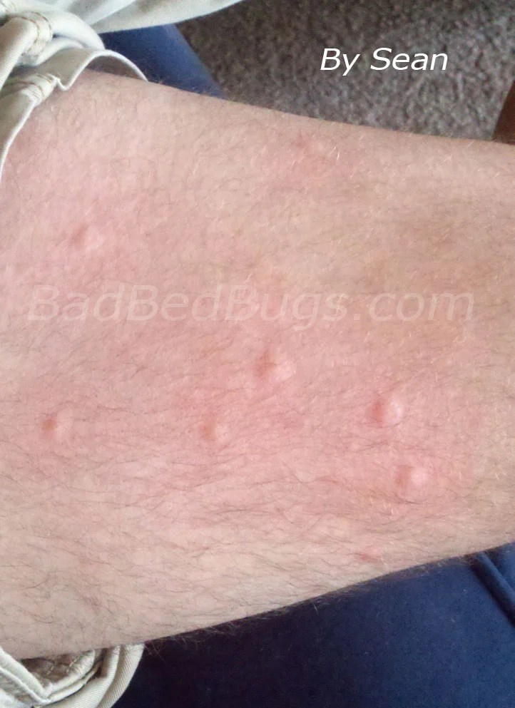 Bed Bug Bite Discussion 1