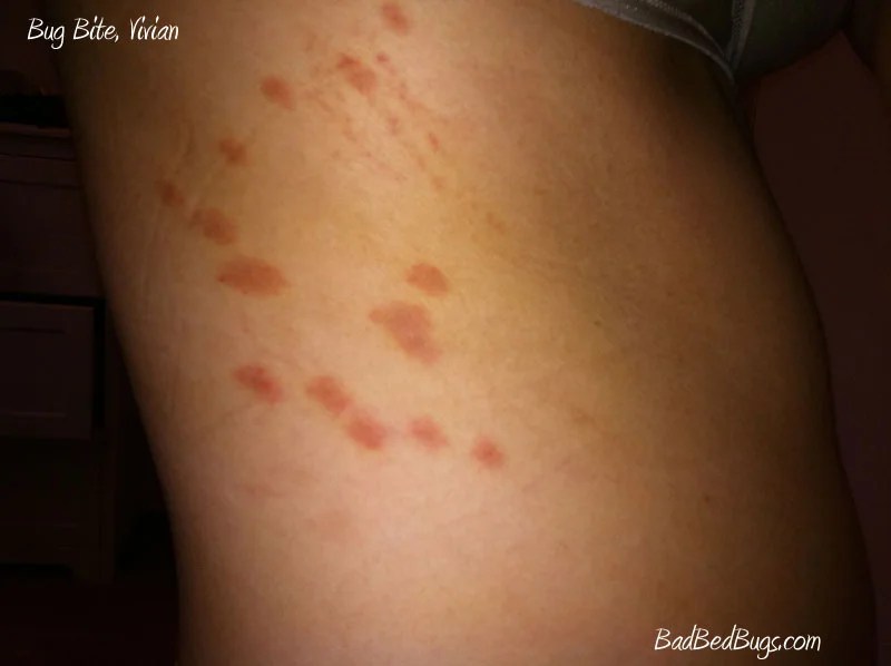 Bedbugs Bites Discussion Pg 2