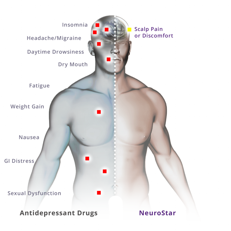 Transcranial Stimulation For Depression What It TMS Therapy?