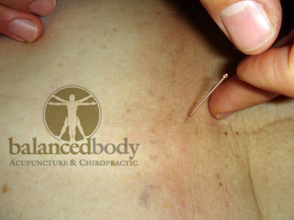 How Much Does Acupuncture Cost? Balanced Body Acupuncture
