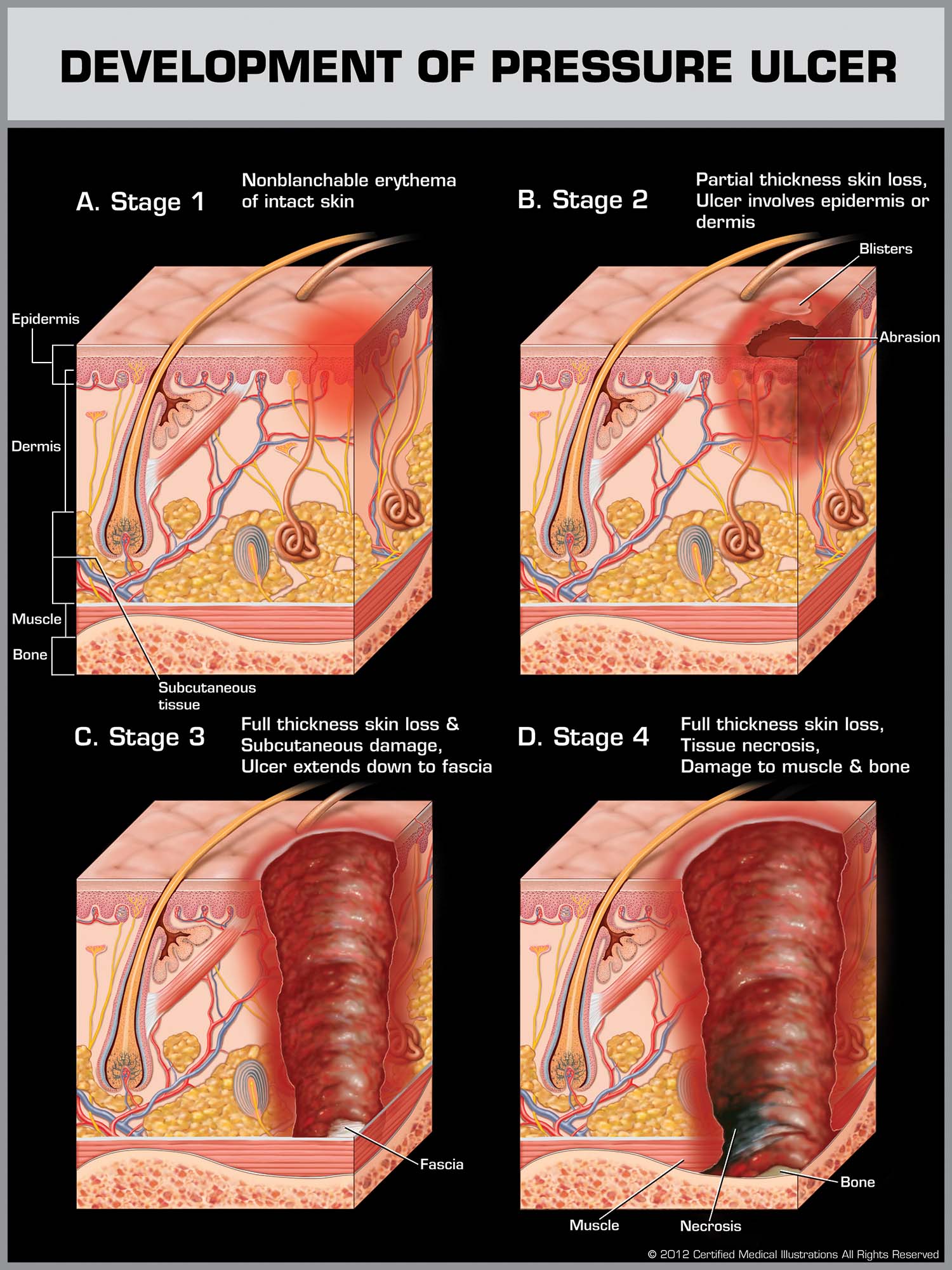 New Jersey Nursing Home Attorney Bedsores & Ulcer Injury