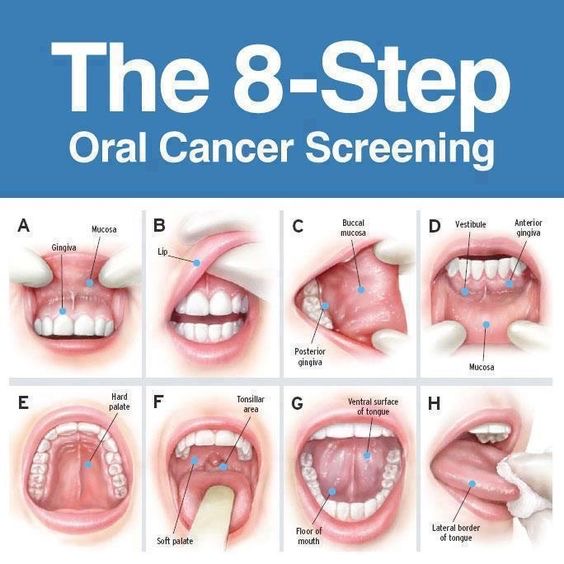 When Should You Get Screened For Oral Cancer? Balsall Common Dental