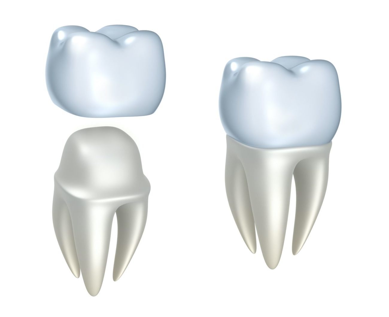 Steps to the Dental Crown Procedure Dentist in Marrero, LA