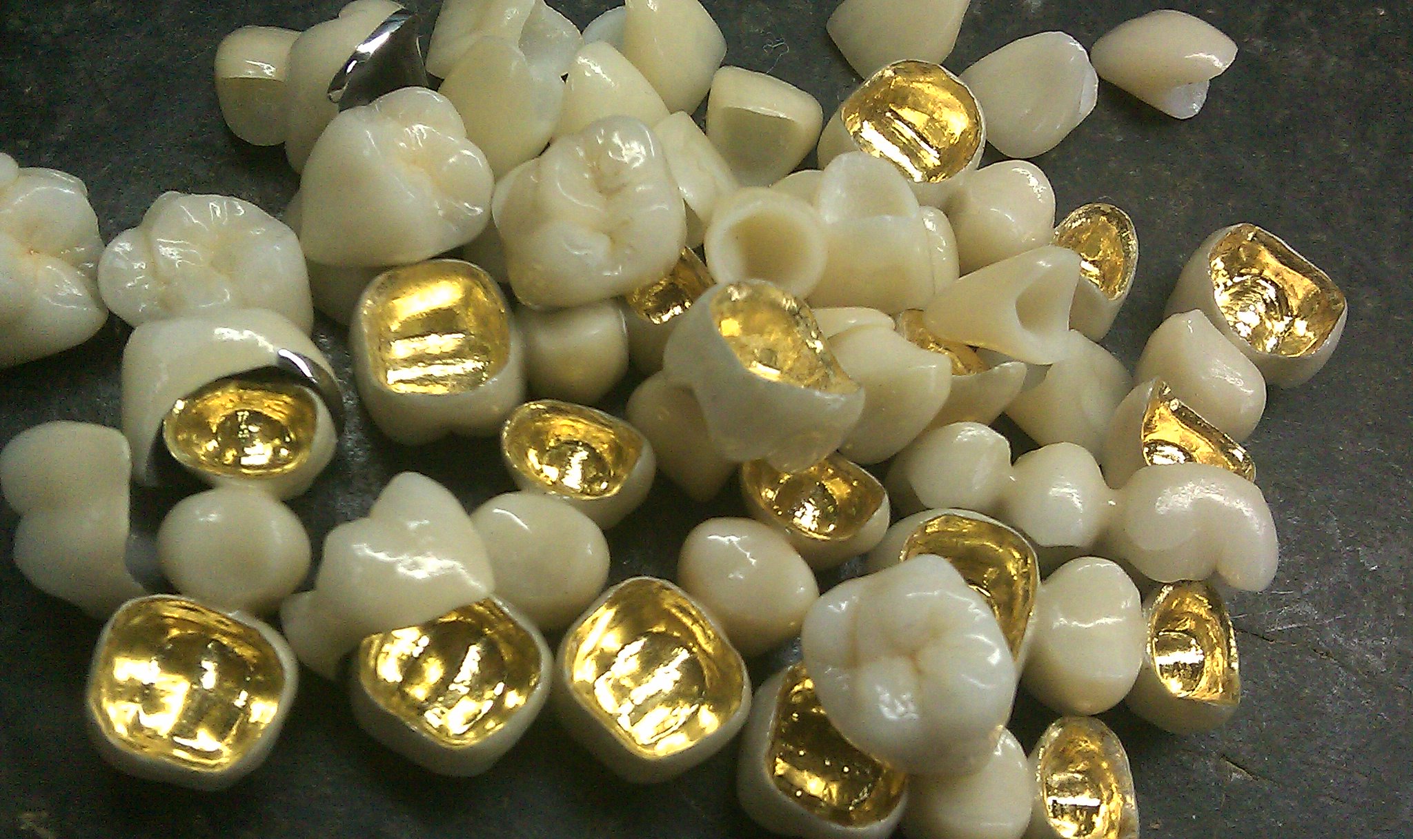 NonPrecious PFM Porcelain Fused to Metal