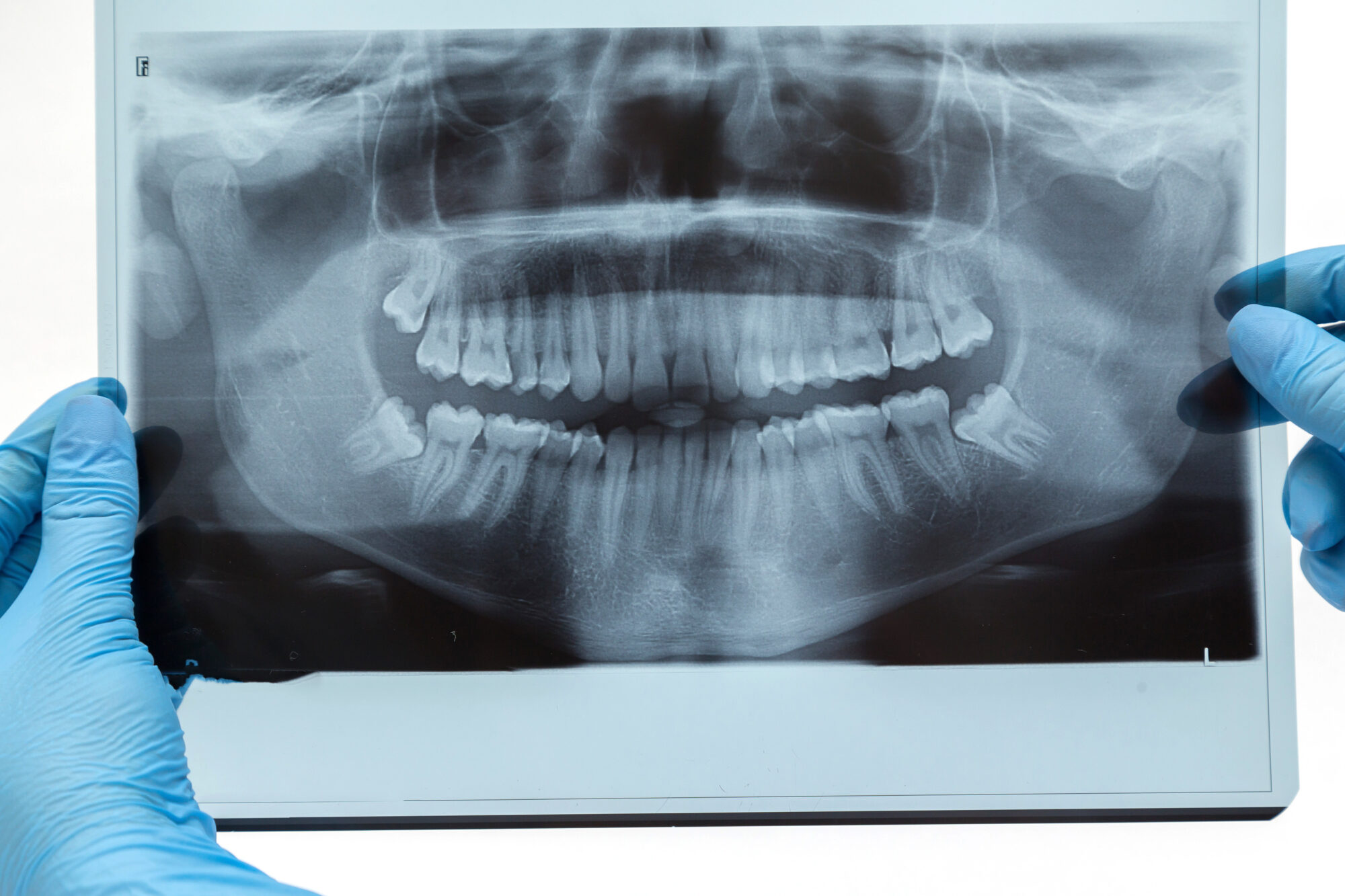 How does a bone graft work?