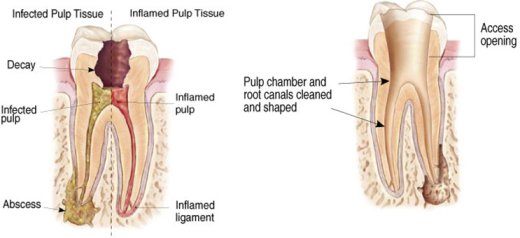 Specialist Dental Care Procedures Bay Endodontics