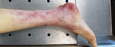 Unexplained Bruising With Elderly In Nursing Homes - Blasingame, Burch, Garrard, Ashley, P.c.