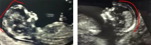 Three Ways To Use Ultrasonography For Early Gender Determination