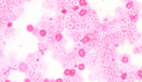 KLEIHAUER BETKE TEST PDF