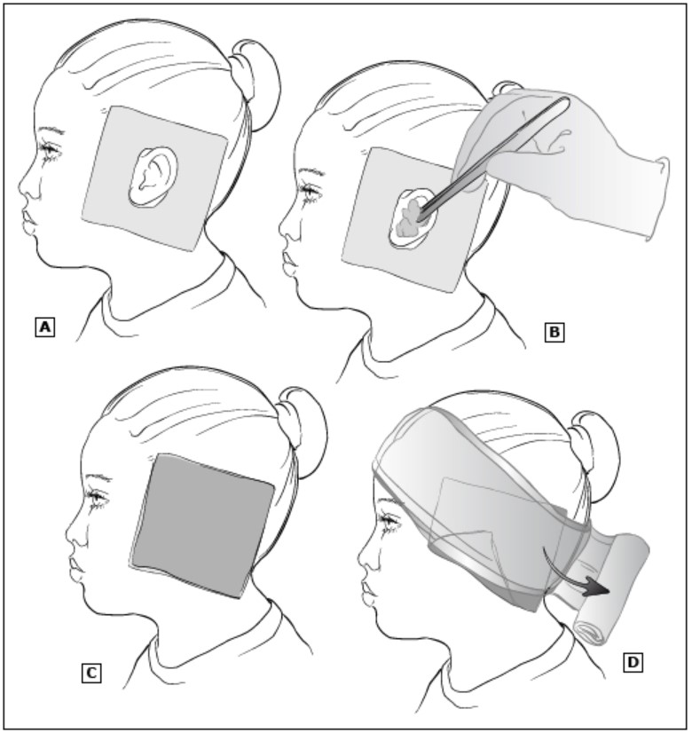 Ear Hematoma Treatment BC Emergency Medicine Network