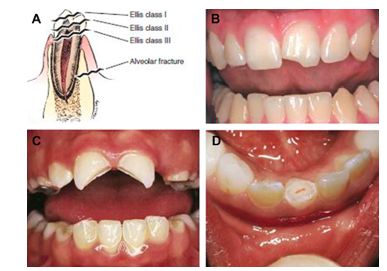 Dental Fracture Diagnosis and Treatment Emergency Care BC