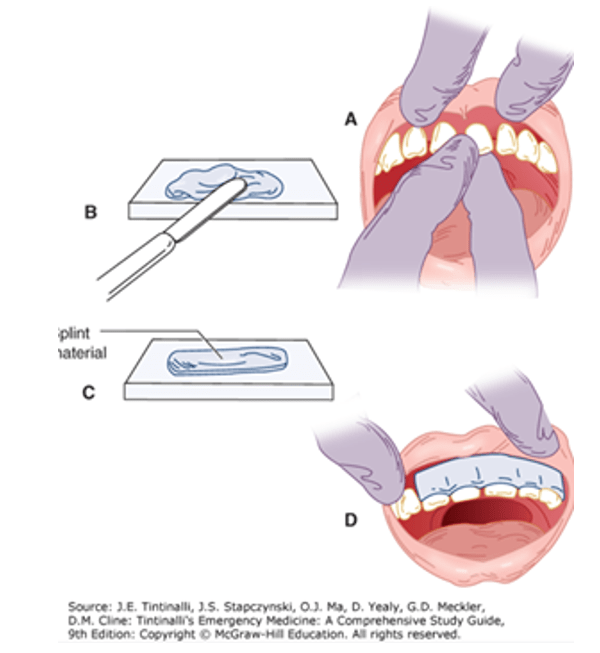 Dental Fracture Diagnosis and Treatment Emergency Care BC