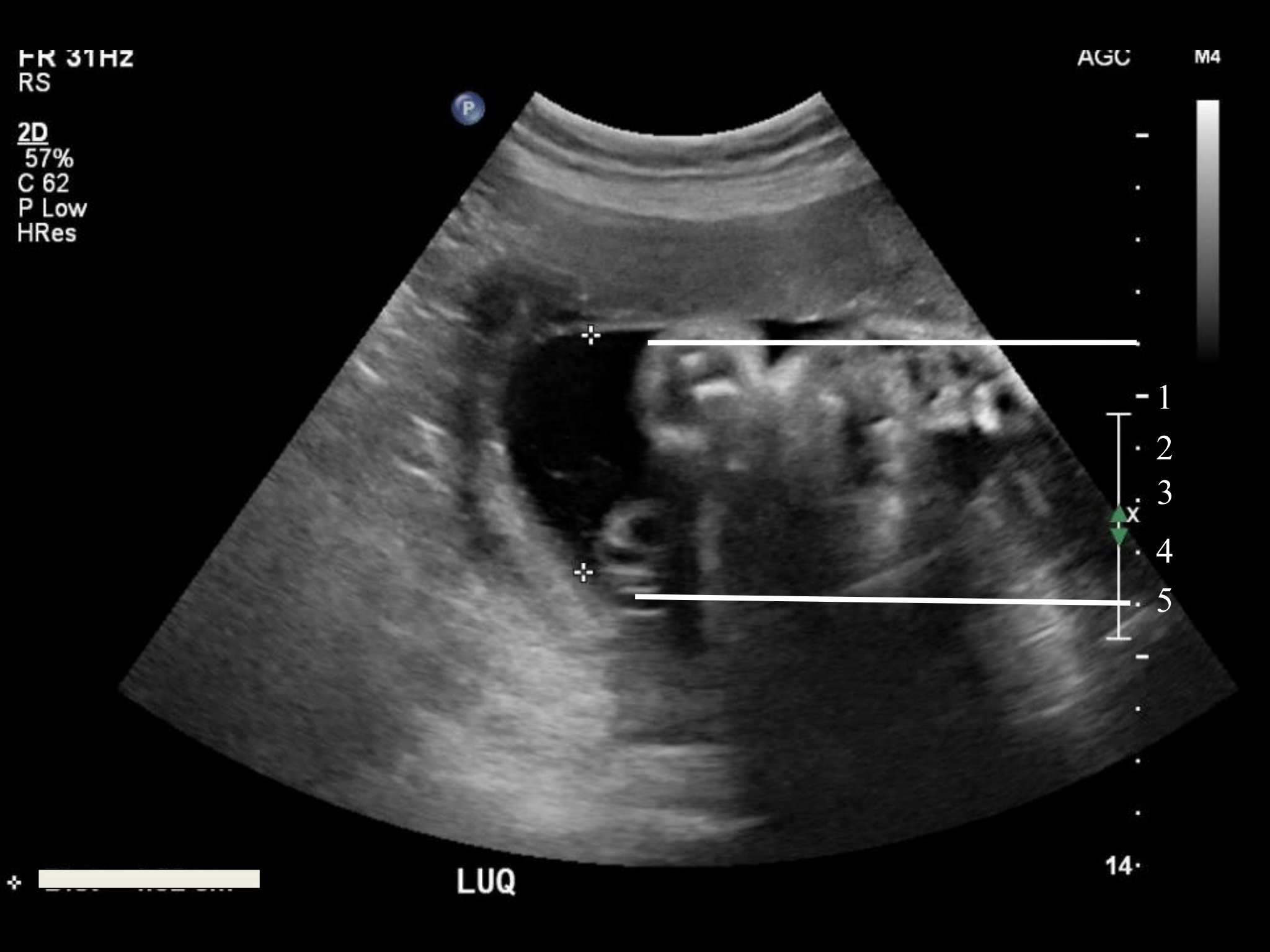 Amniotic Fluid BCPoCUS