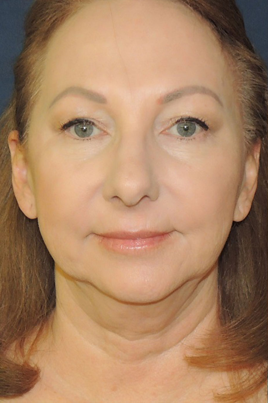 Genioplasty (Chin Surgery) Stephen P. Beals, M.D.