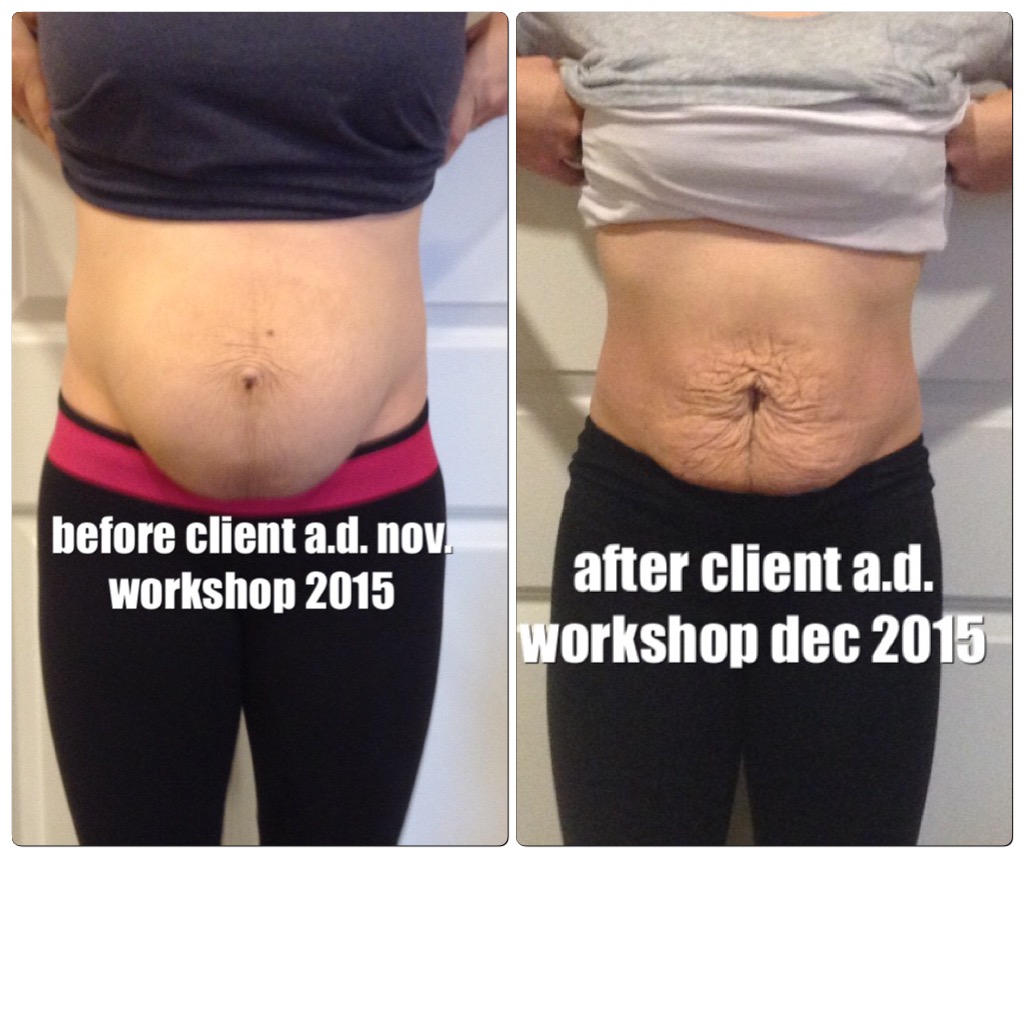 All New Before and After Pictures Healing the Diastasis Recti 2015