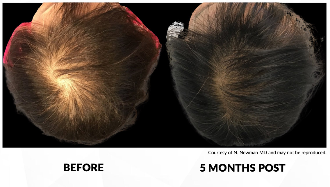 Laser Hair Removal Kamloops Beautiful U