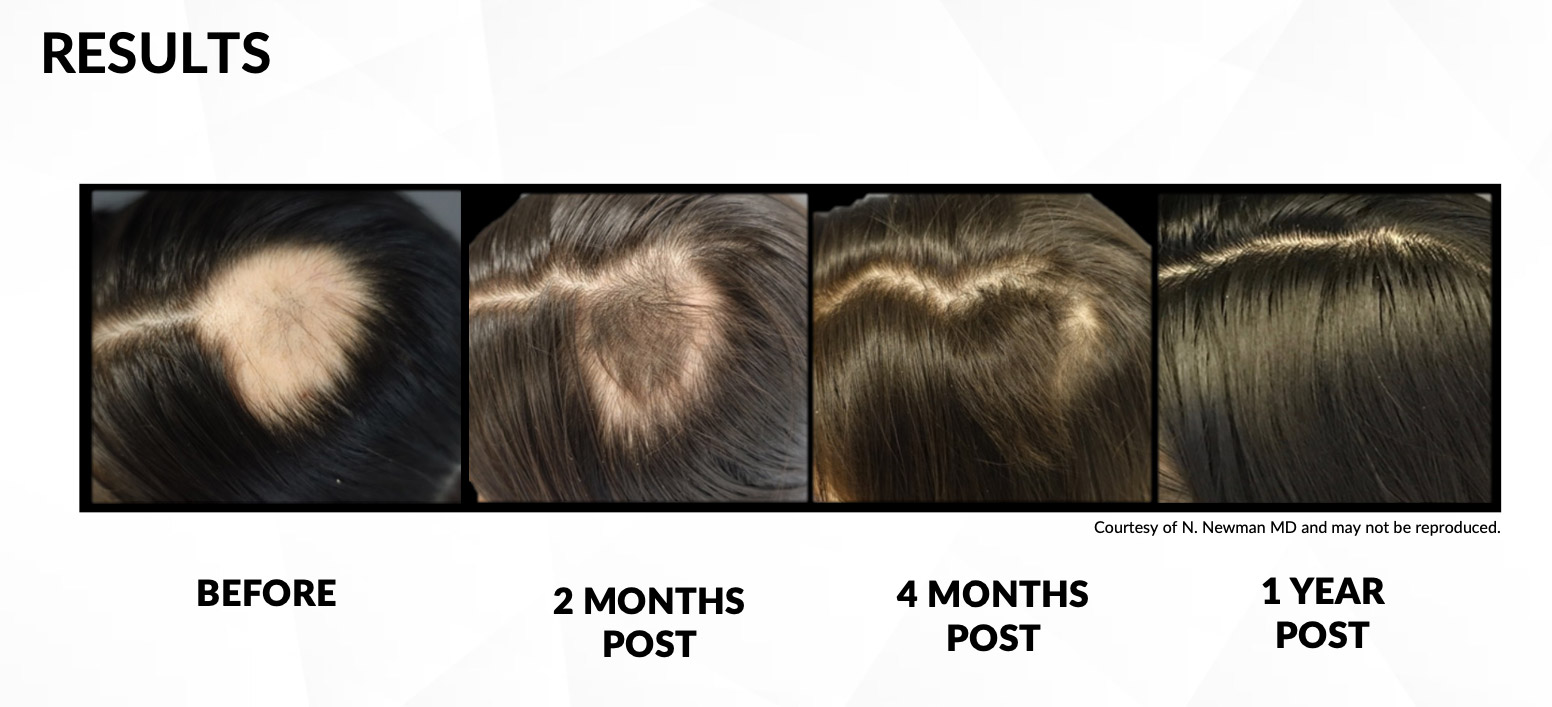 Laser Hair Removal Kamloops Beautiful U