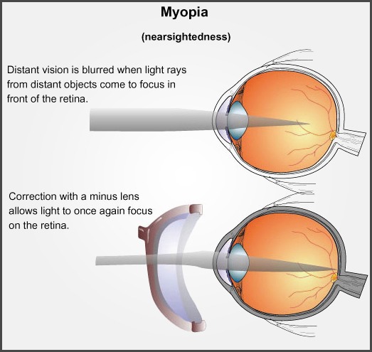 Myopia (Short Sightedness) Beckenham Optometrist