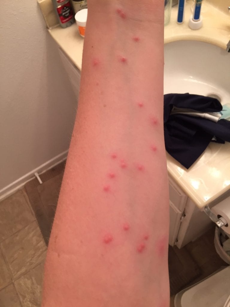 Bed Bug Bites Don't Affect Everyone Bed Bug Barbeque