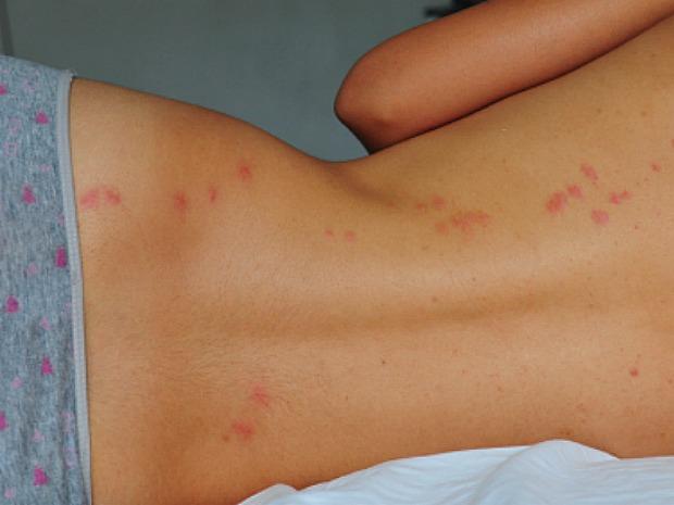 Do Bed Bug Bites Itch? Bed Bug Guide