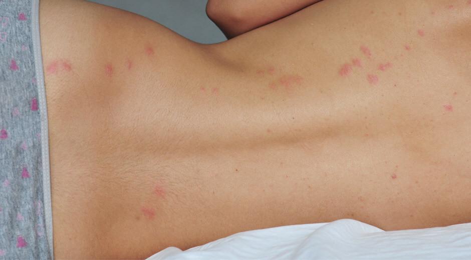 What To Know About Bed Bug Bites Bed Bug Guide