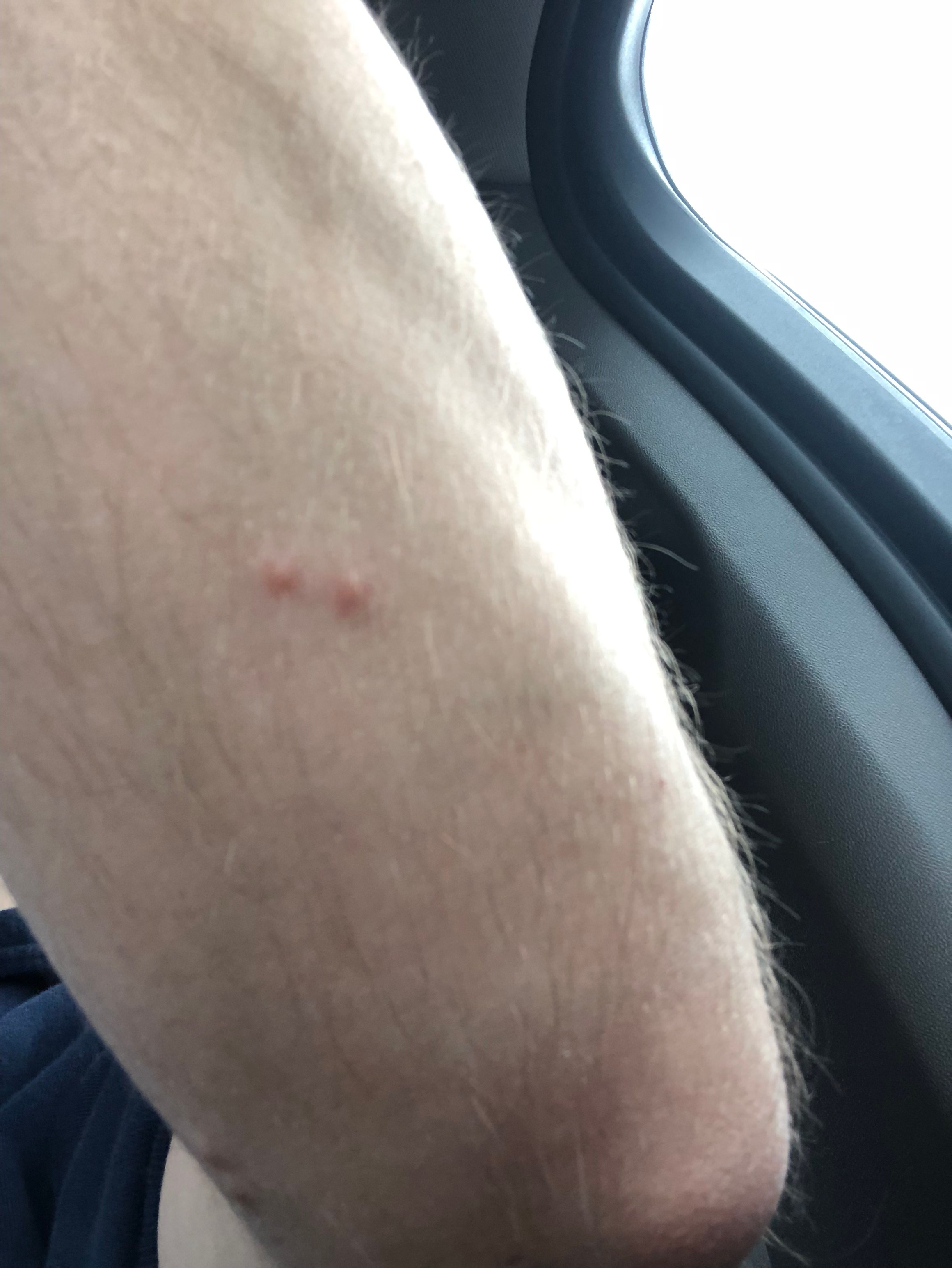 Bed Bug Reports Check Hotels and Apartments Before You Stay