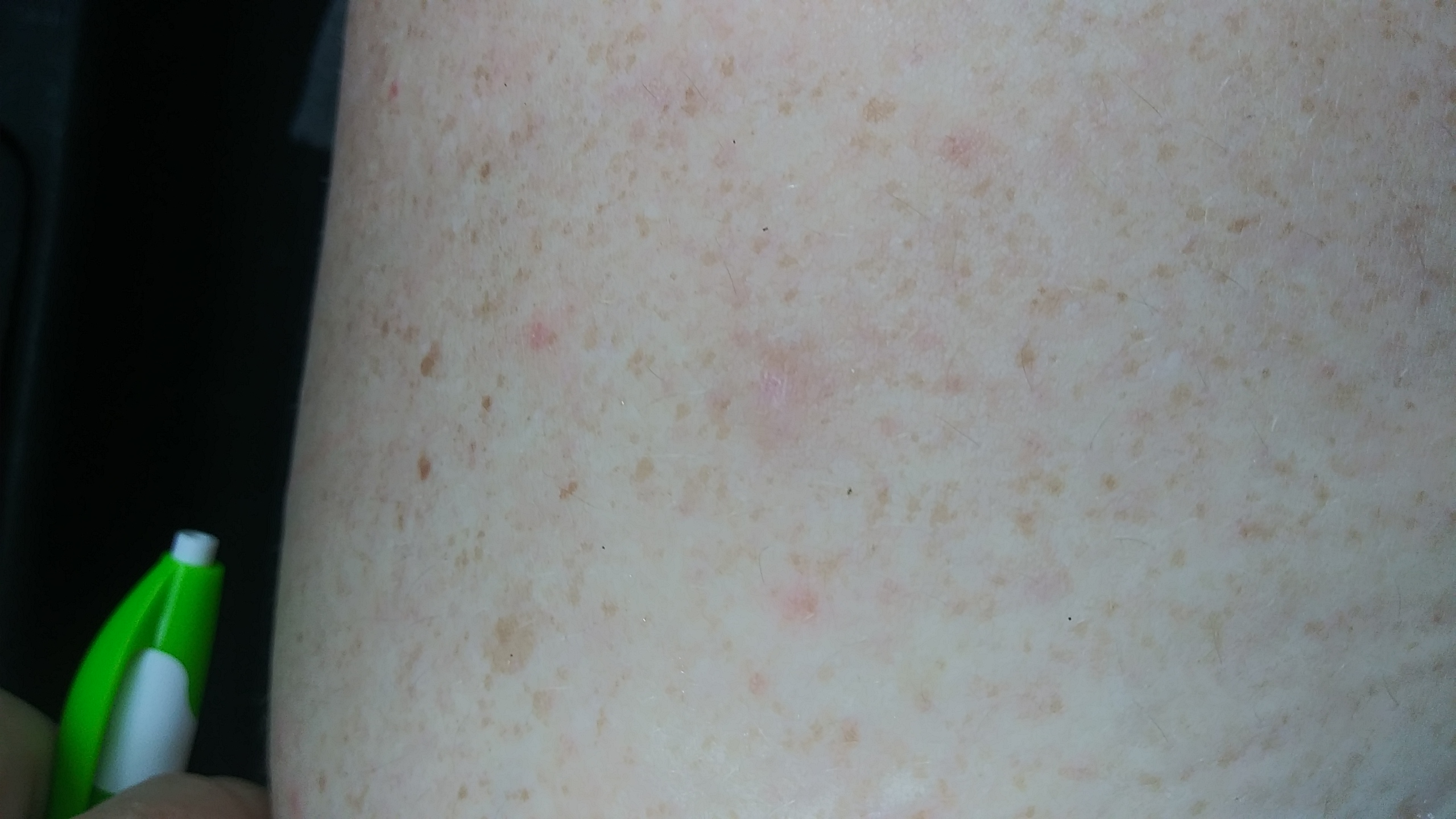 Bed Bug Reports Check Hotels and Apartments Before You Stay