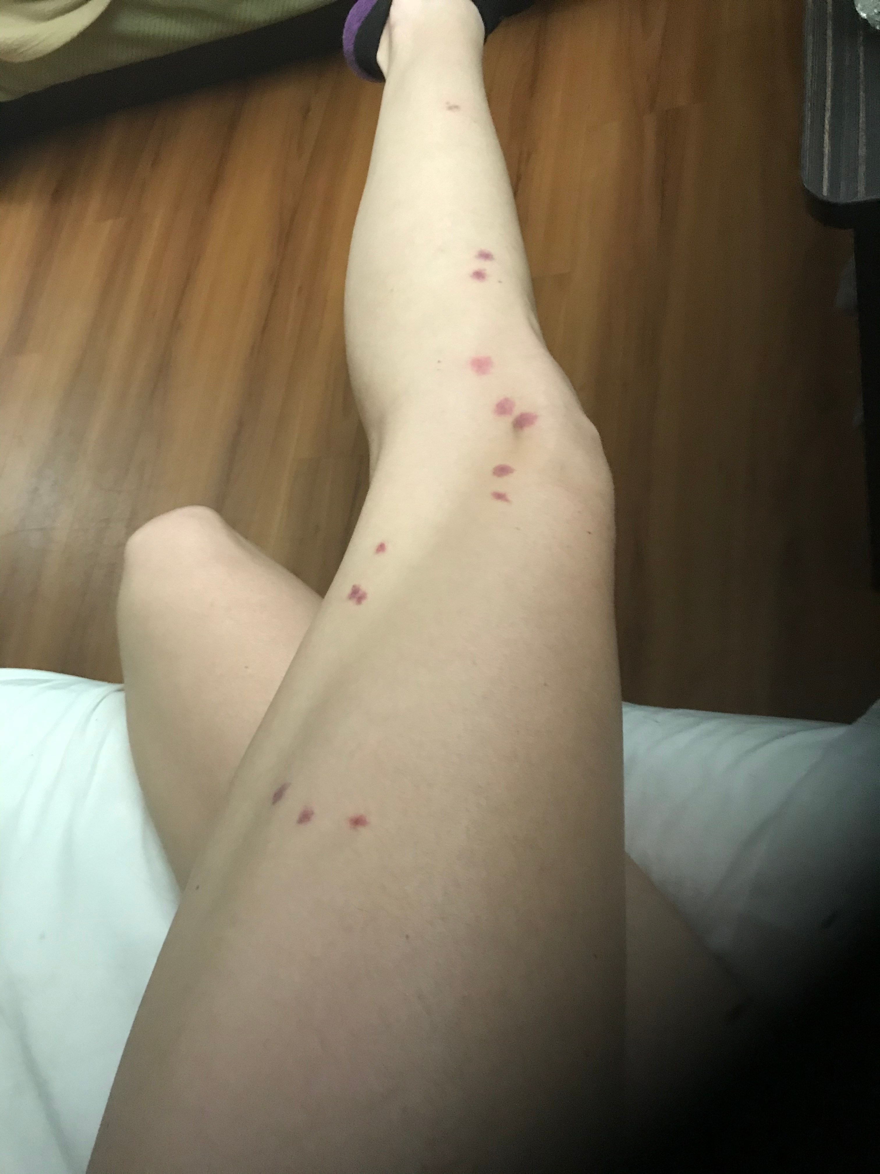 Bed Bug Reports Check Hotels and Apartments Before You Stay