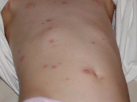 Baking Soda Uses For Skin Rashes