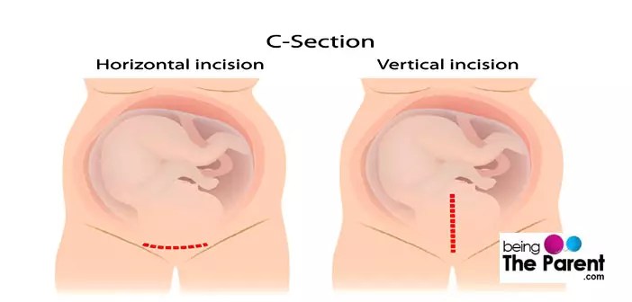 Bleeding and Breastfeeding After A C-Section | Being The Parent