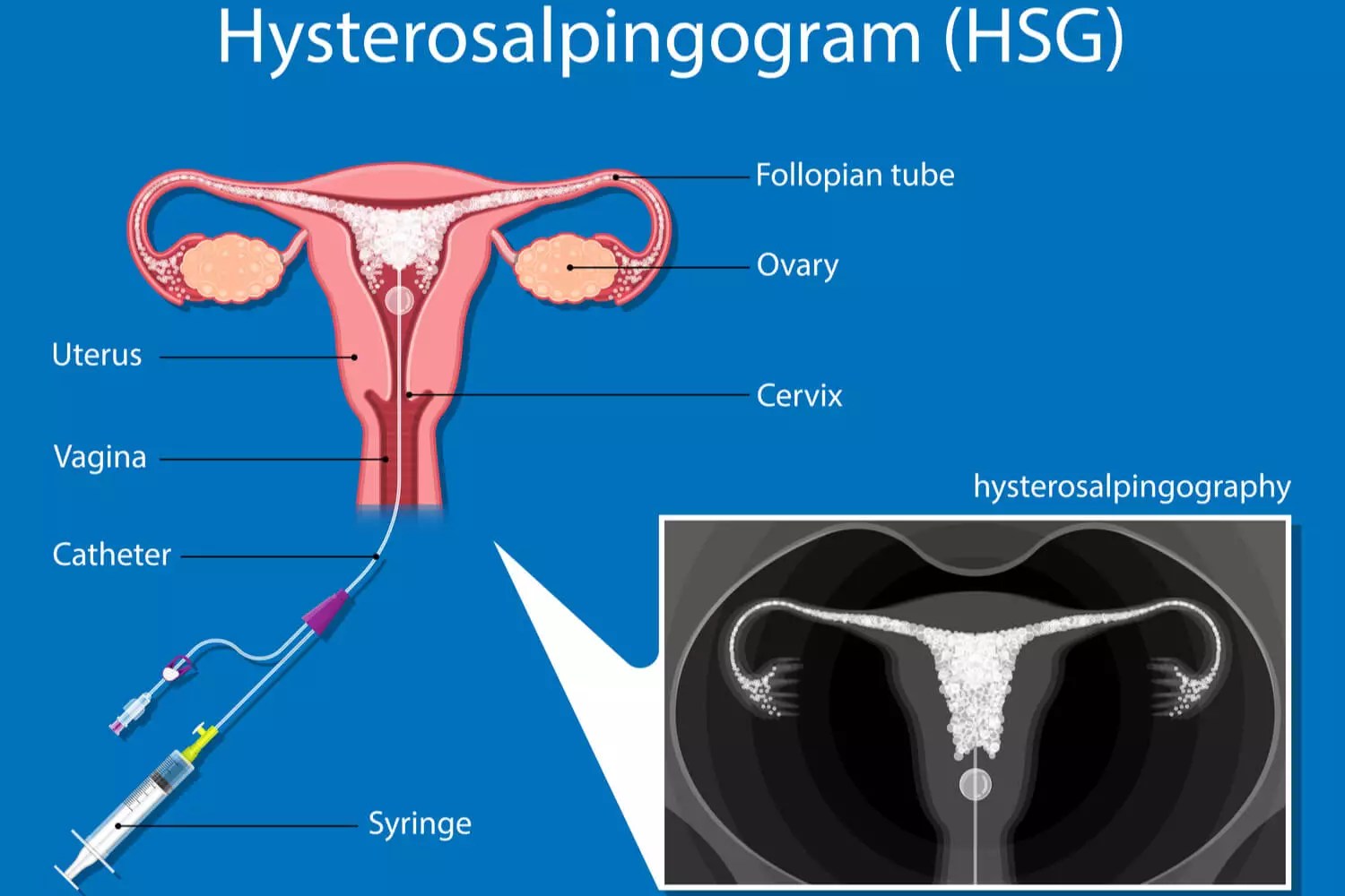 Blocked Fallopian Tubes Types, Causes And Treatments Being The Parent