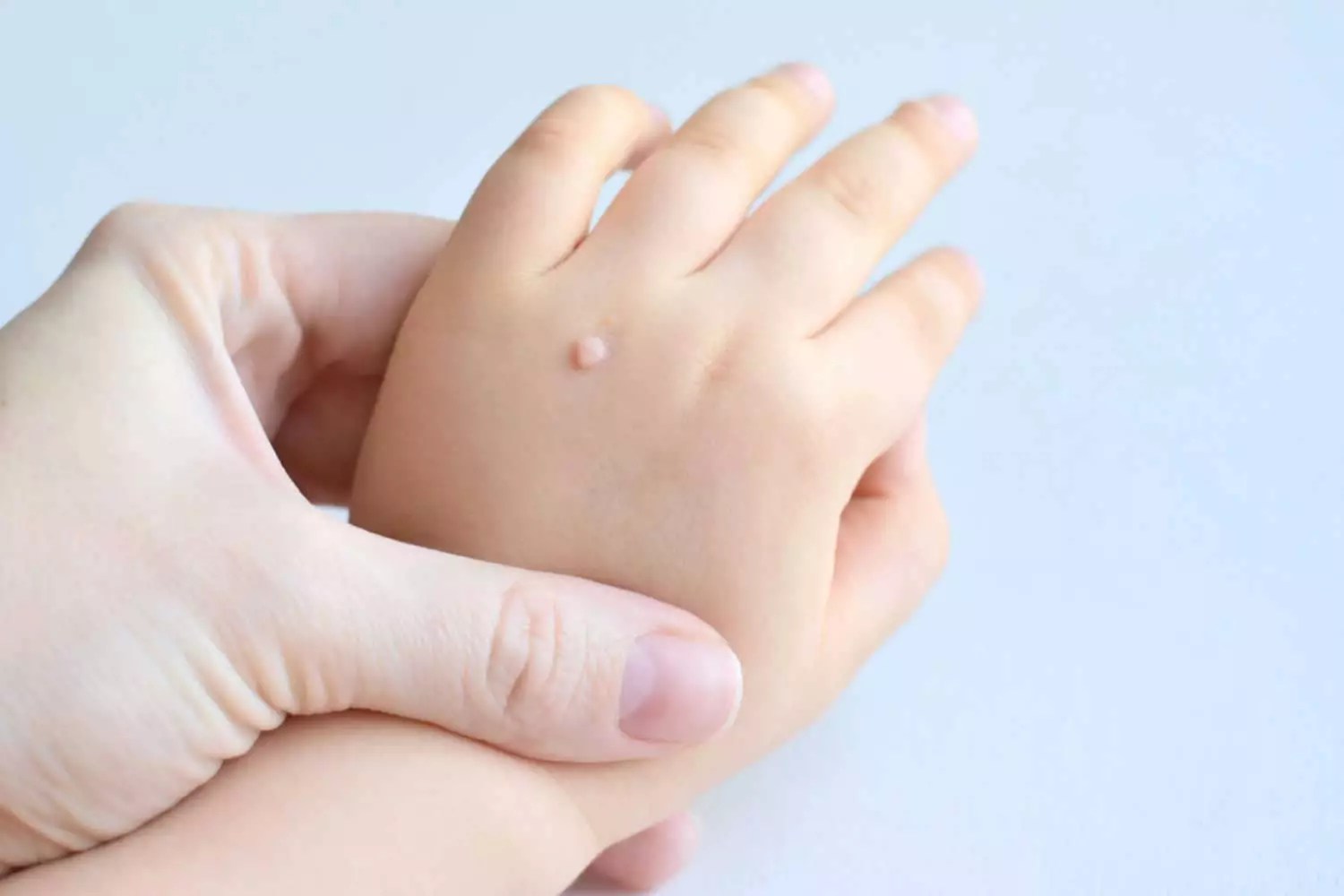 Warts In Babies Everything You Need To Know Being The Parent