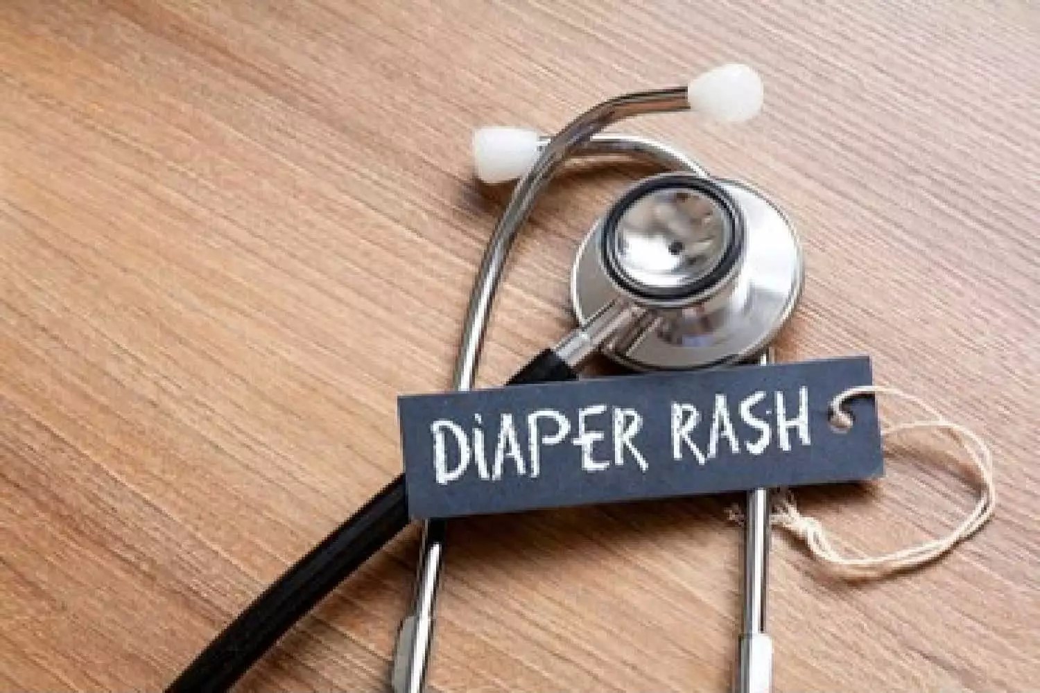 Diaper Rashes Causes, Treatment, Home Remedies and Precautions Being The Parent