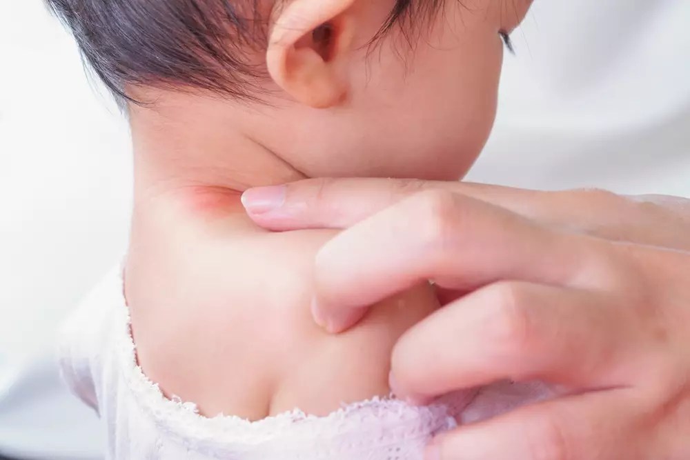 Baby Neck Rash Causes, Symptoms & Remedies Being The Parent