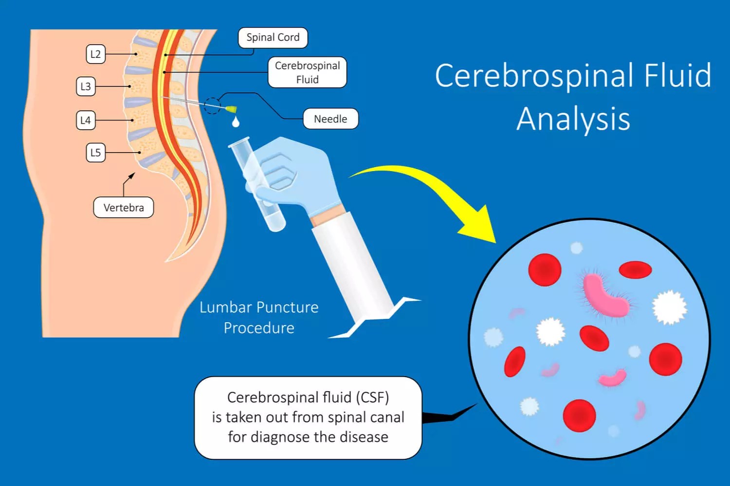 Understanding Leukaemia in Children Causes & Diagnosis