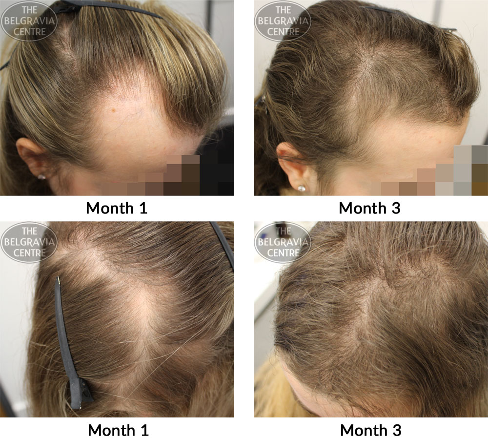 Alopecia Areata Treatment