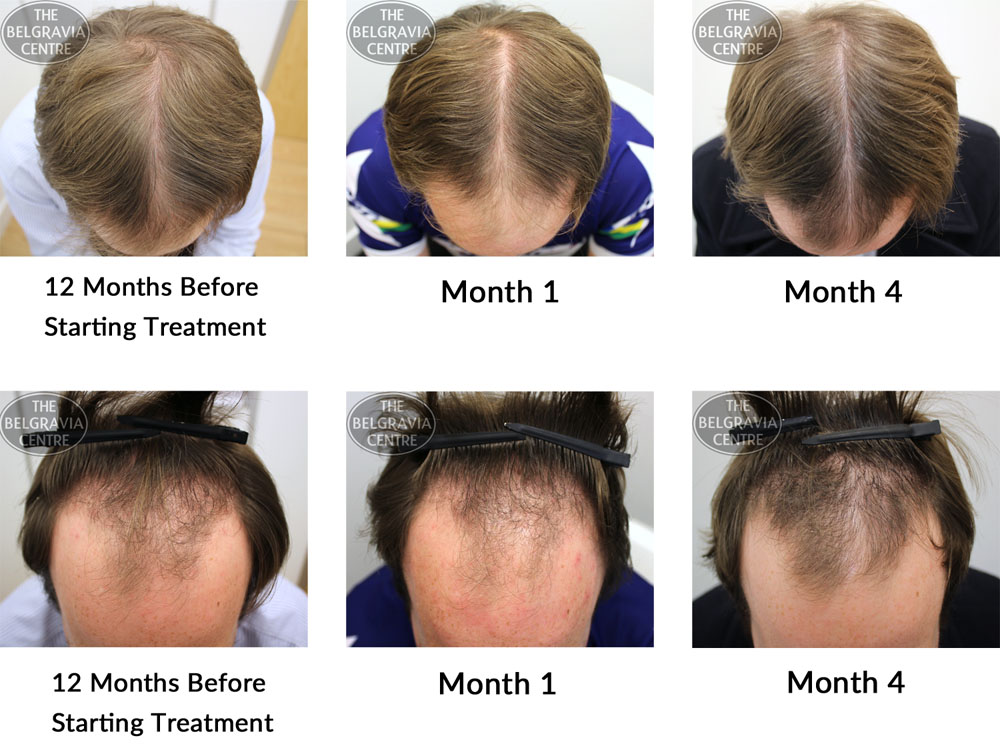 Success Story Alert! New Male Hair Loss Treatment Entry