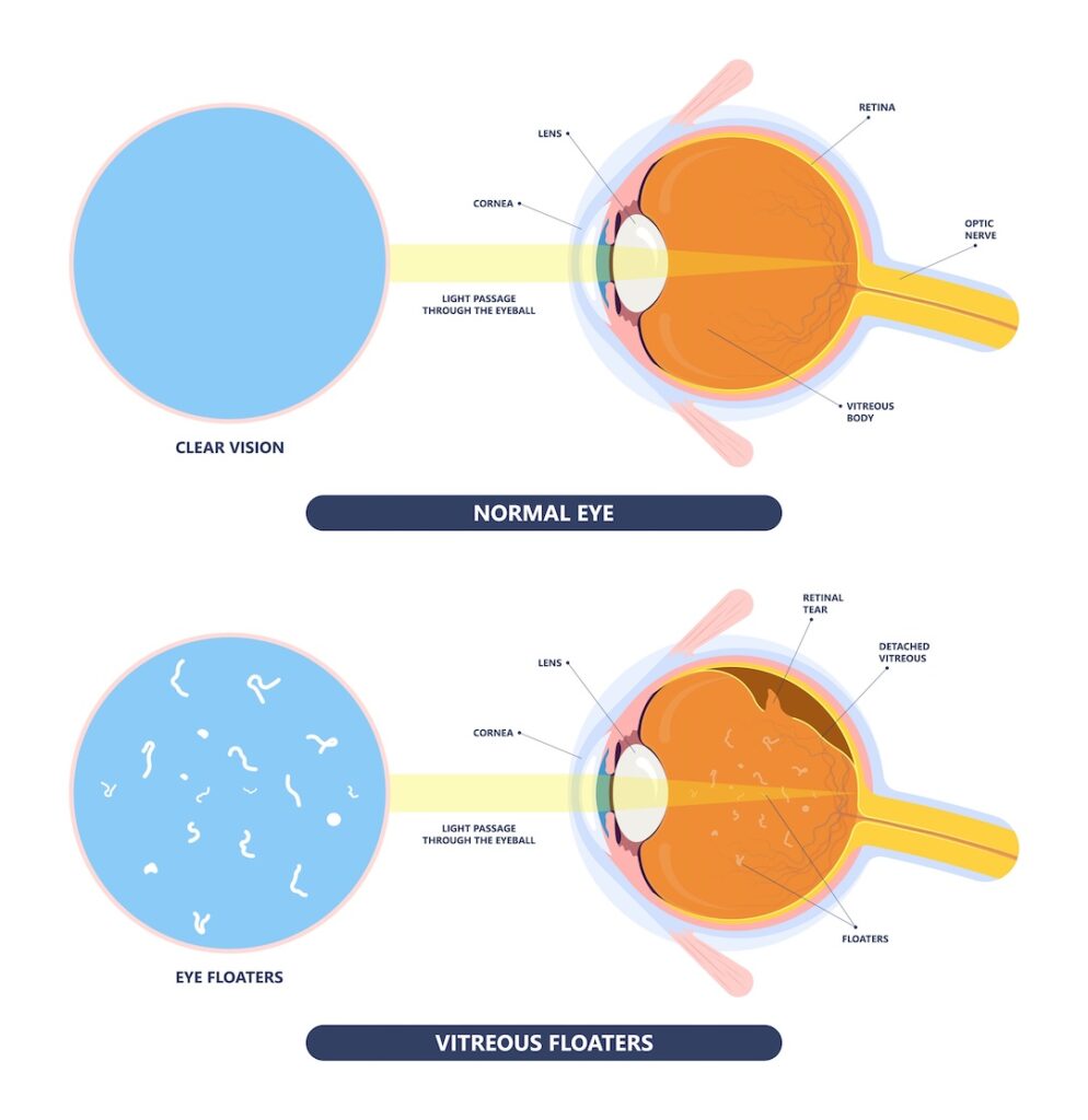 Eye Floaters Bellamy Eyecare Opticians