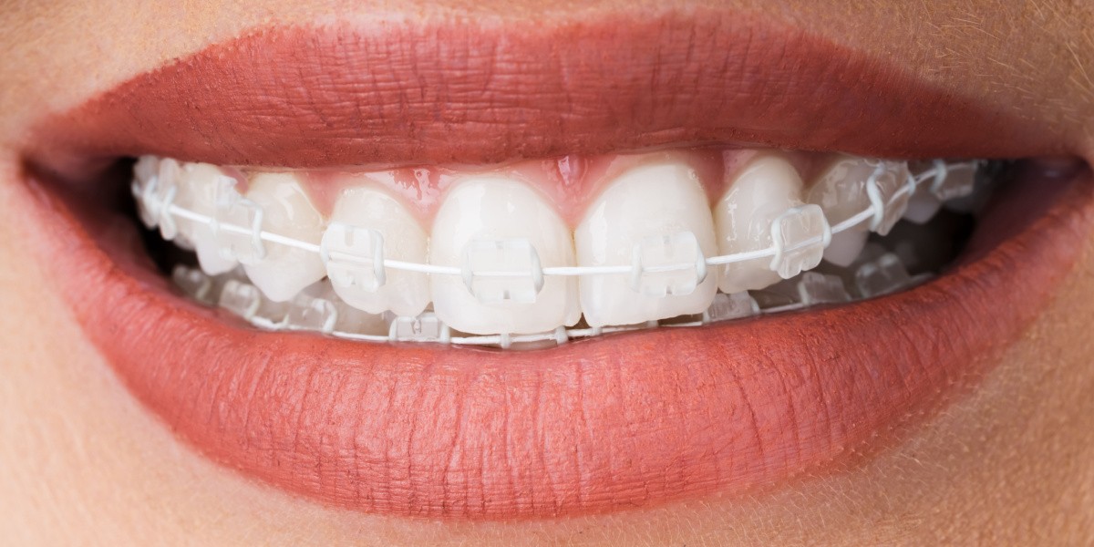 Brackets estéticos Tipos y beneficios