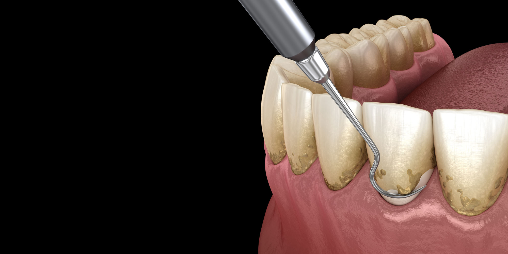 Scaling And Root Planing No Anesthesia at Priscilla Sandoval blog
